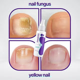 Jaysuin Nail Fungus Spray 100ml – Nail & Foot Care Spray